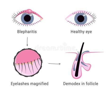Illustrazione microscopica degli acari Demodex sulle ciglia.