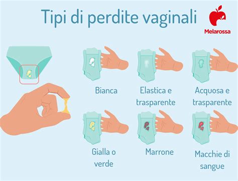 schema che illustra le diverse tipologie di perdite vaginali in gravidanza e le loro possibili cause