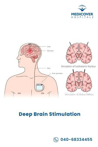 Schema che illustra il funzionamento della stimolazione cerebrale profonda (DBS).