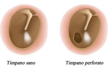 Immagine di un timpano normale a confronto con un timpano retratto e uno perforato a causa di barotrauma.