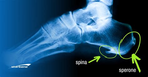 Illustrazione che mostra la differenza tra lamina del tallone e lamina della punta in snowboard.