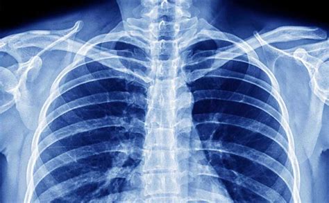 radiografia del torace che evidenzia una frattura costale